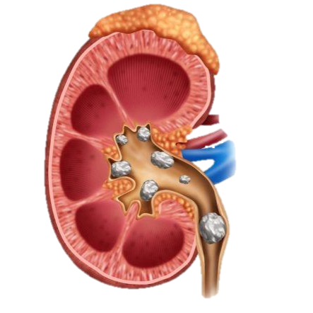 kidneystones