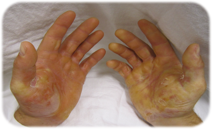 Hands of an EBS patient