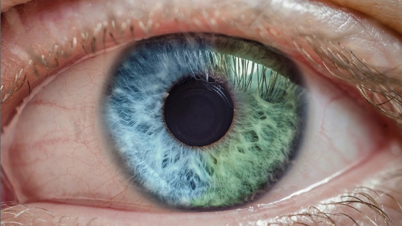 partial heterochromia